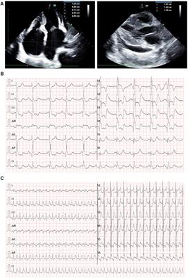 Challenging of ECMO application in pediatric restrictive cardiomyopathy: case report of a novel TNNI3 variant